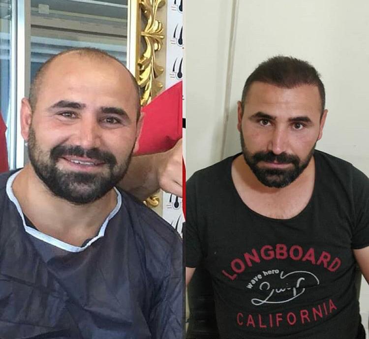 Haartransplantation bei Männern