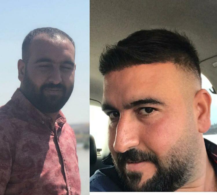 Erkeklerde Saç Nakli