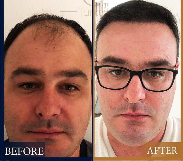 Haartransplantation bei Männern