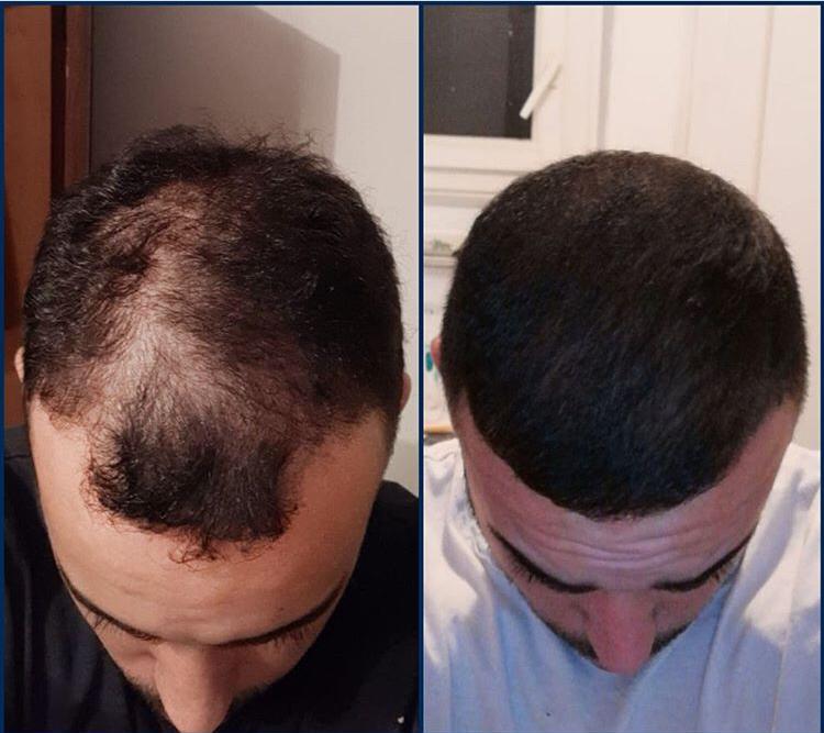Haartransplantation bei Männern
