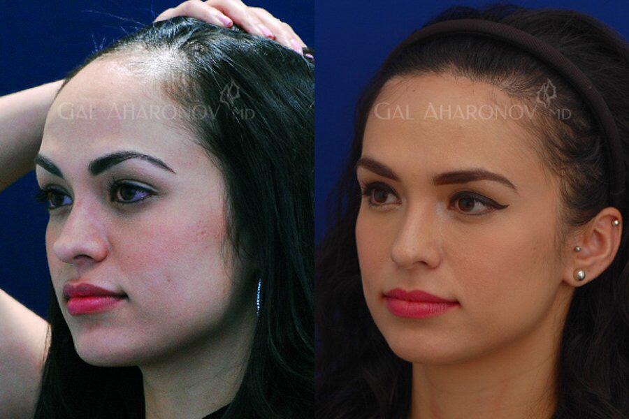 Haartransplantation bei Frauen