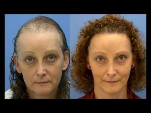 Haartransplantation bei Frauen