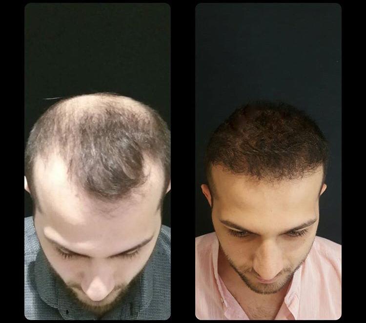 Erkeklerde Saç Nakli