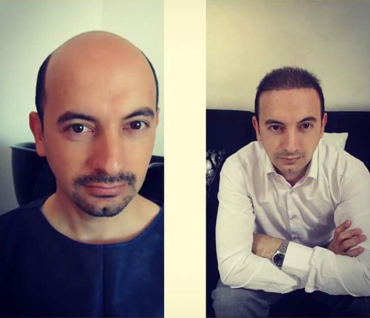 Erkeklerde Saç Nakli