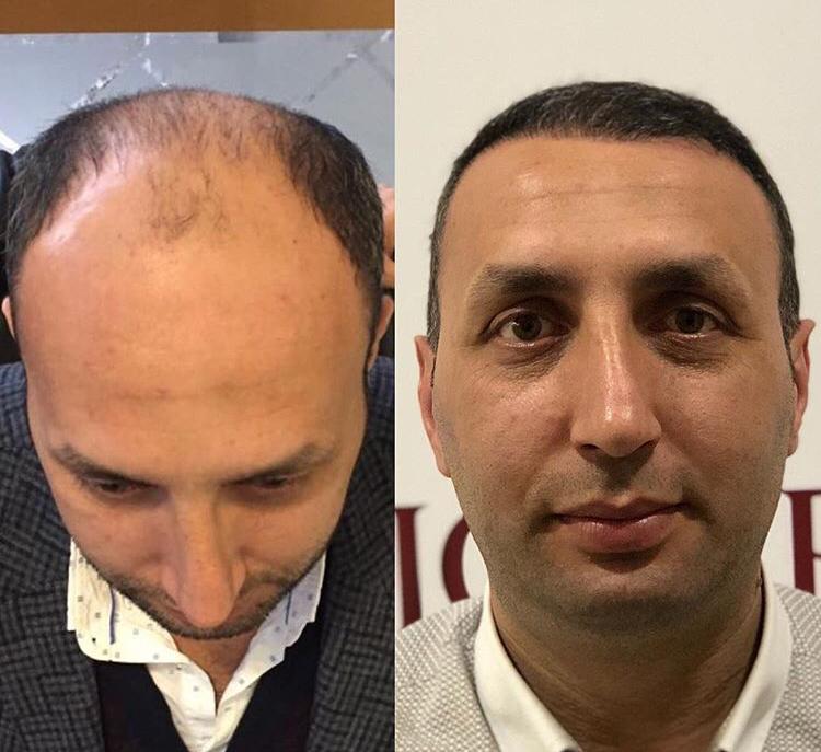 Erkeklerde Saç Nakli