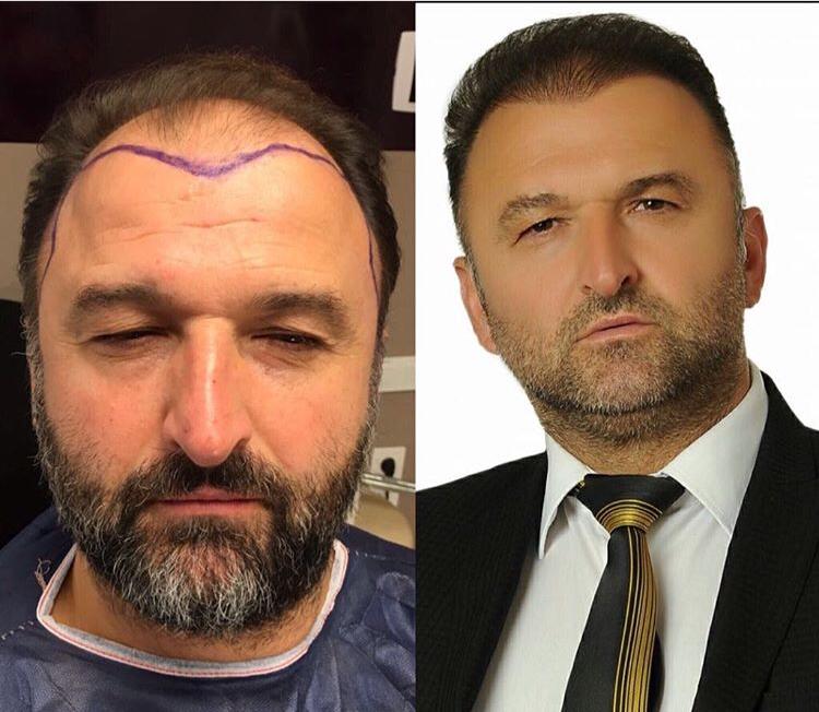 Erkeklerde Saç Nakli