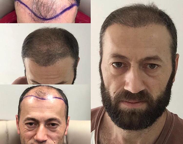 Erkeklerde Saç Nakli