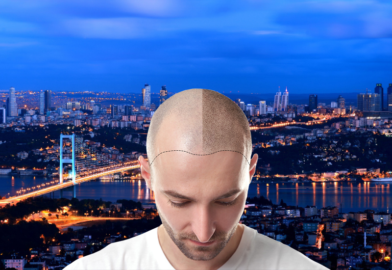 THE 3 DAYS HAIR TRANSPLANTATION PACKAGE IN ISTANBUL